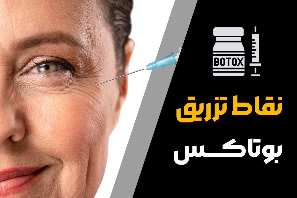 نقاط تزریق بوتاکس